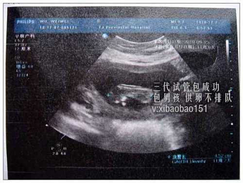 北京代生孩子,父母染色体异常-美国试管婴儿可以得到健康囊胚吗