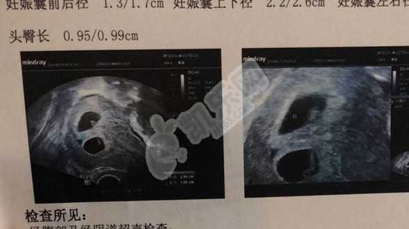 代怀孕最北京专业的是哪家,试管婴儿存在哪些弊端呢